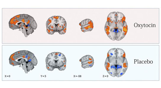 研究显示催产素改善自闭症儿童的脑功能