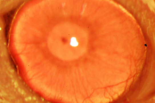 人类角膜的新方法可以帮助克服一项失明的主要原因