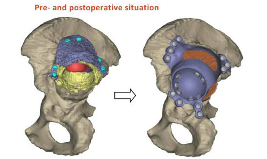 医生用3D印刷植入物和骨干细胞移植物完成髋关节手术