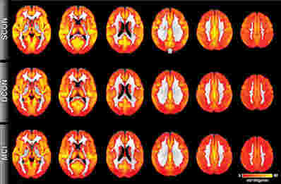 非侵入性动脉旋转标记MRI检测在症状出现之前的认知下降的证据