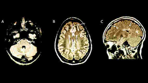 研究人员使用MRI大脑扫描来揭示儿童MS风险