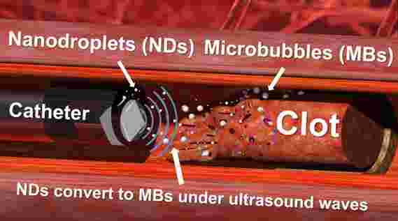 超声波“钻头”和纳米液滴证明对解决顽固的血凝块有效