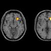 大脑的主要区域在具有双相障碍的青少年中的不同程度地发展