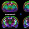 研究显示MRI检测精神分裂症的早期迹象