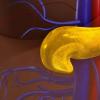 耶鲁大学的新研究表明对氧磷酶2促进胰腺癌的生长