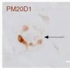 PM20D1基因的变异与培养的Alzheimer疾病的风险增加