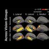 功能磁共振成像显示大脑如何修复未使用的区域