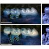 新发现的牙龈中的化学感应细胞可保护牙周炎