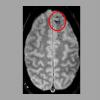 微斑秃 - 在CT扫描上被检测到太小 - 可能会在头部受伤后恶化结果