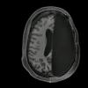 大脑扫描揭示了人脑如何在移除一个半球时如何补偿[视频]
