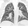 关于评估的知名：诊断急性肺损伤与Vaping相关