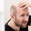 基于干细胞的新型局部解决方案可帮助秃头人恢复头发生长