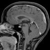 常见的大脑畸形–影响约100名儿童中的1 –追溯到其遗传根源