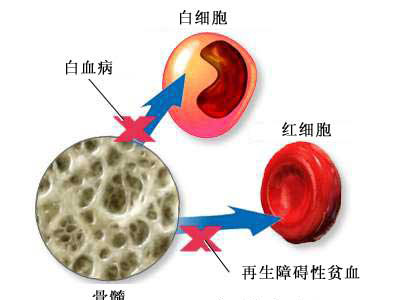 磷灰石水泥骨块(CPC)及其浸出液的制备羟基磷灰石人工骨,