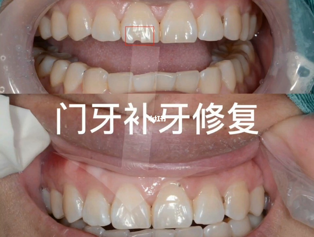 北京芽美口腔：补牙需要多少钱要依据牙齿损坏的程度