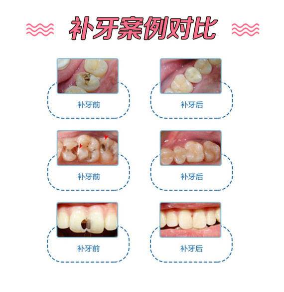 塑钢牙和树脂牙哪种好_树脂牙和烤瓷牙_树脂牙多少钱一颗