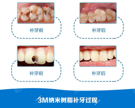 塑钢牙和树脂牙哪种好_树脂牙和烤瓷牙_树脂牙多少钱一颗