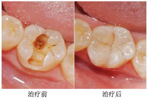 塑钢牙和树脂牙哪种好_树脂牙和烤瓷牙_树脂牙多少钱一颗