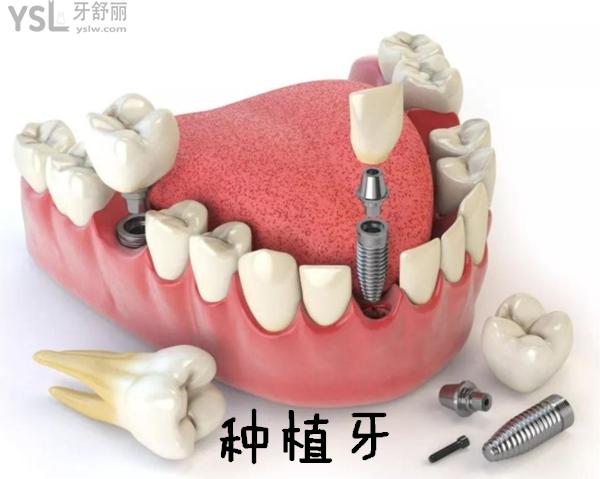 塑钢牙和树脂牙哪种好_树脂牙多少钱一颗_树脂牙贴面价格