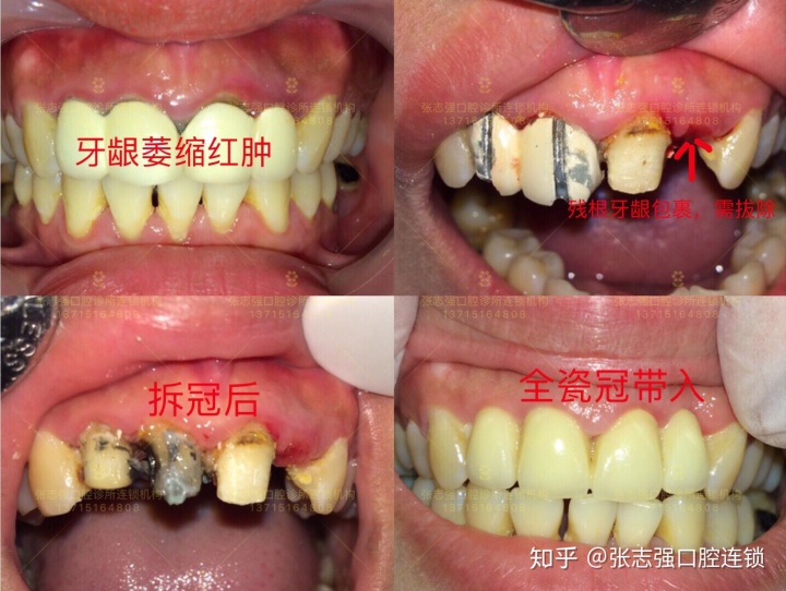 塑钢牙和树脂牙哪种好_树脂牙贴面价格_树脂牙多少钱一颗