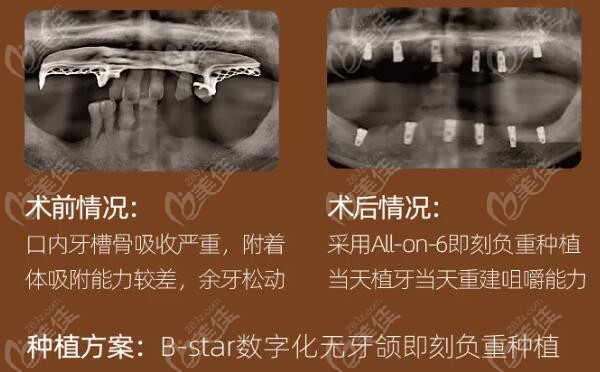 牙齿是人的第二张，还会影响全身健康吗？！