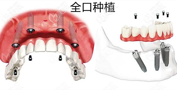 树脂牙和陶瓷牙哪个好_上海齿科树脂牙_树脂牙多少钱一颗