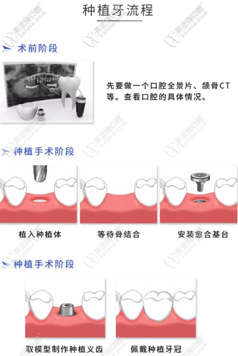 上海齿科树脂牙_树脂牙和陶瓷牙哪个好_树脂牙多少钱一颗