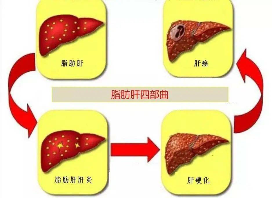 肝脂肪浸润是什么意思_脂肪肝会死吗_脂肪填充脂肪会移位吗