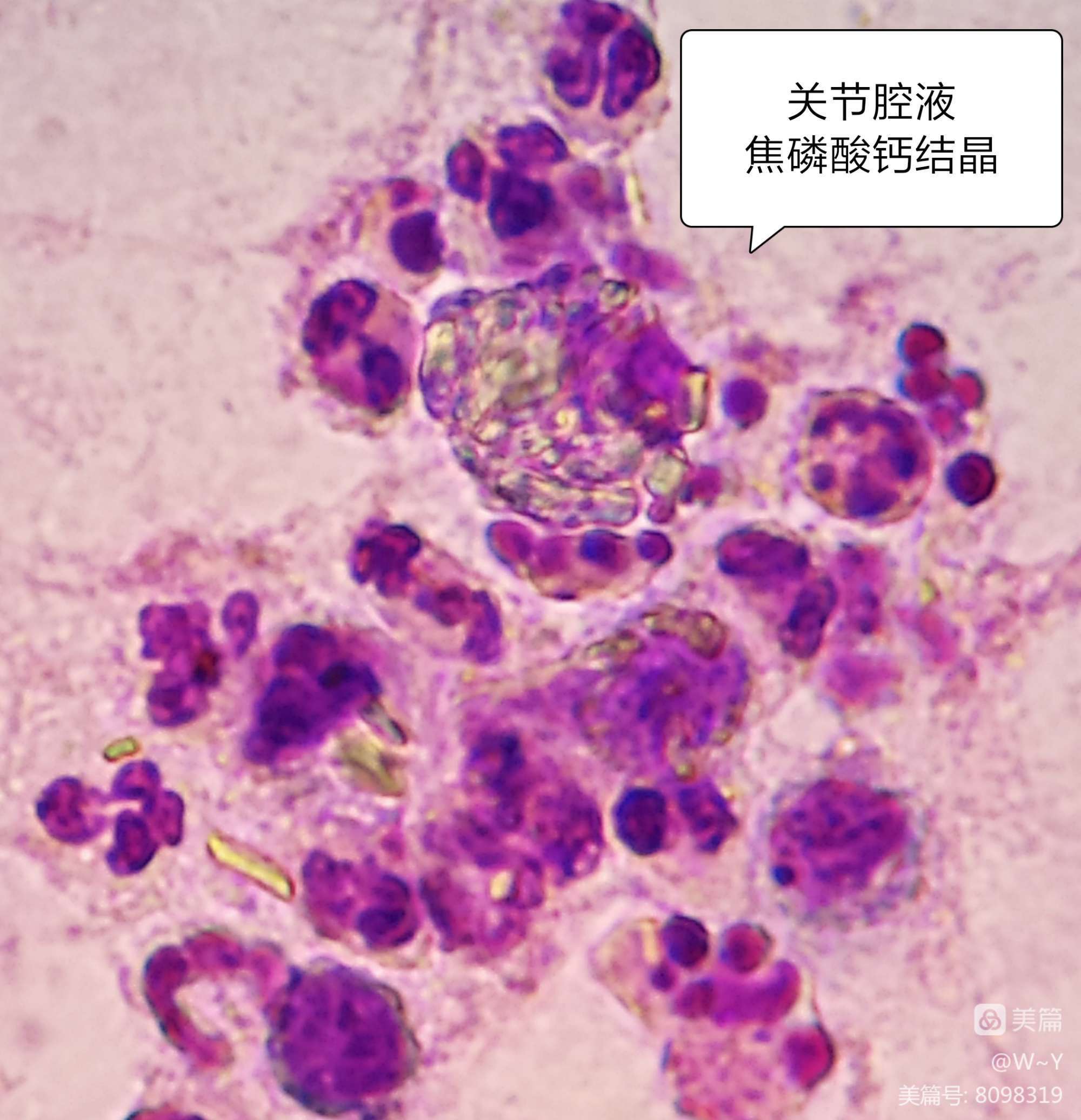 医学生钙化性肌腱炎的鉴定与鉴定方法（一）