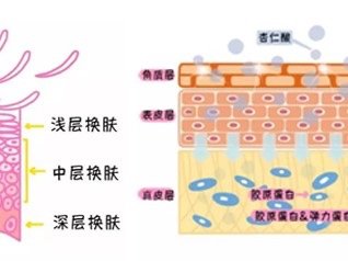 你的皮肤适不适合刷酸吗？的是什么？